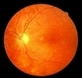 Augenhintergrund, diabetische Retinopathie