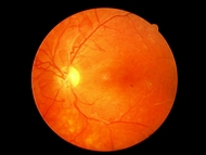 Die diabetische Retinopathie ist eine Augenerkrankung der Netzhaut, bei der die kleinen Gefäße am Augenhintergrund betroffen sind