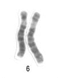 Neue Risikogene fr Typ 1 Diabetes konnten auf den Chromosomen 6 und 21 identifiziert werden