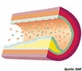 Arteriosklerose