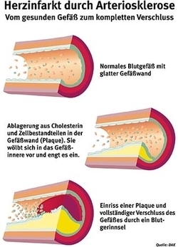 Herzinfarkt durch Arteriosklerose