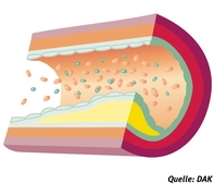 Arteriosklerotisches Gefäß 