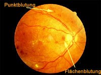 Punkt- und Flächenblutung beim Auge